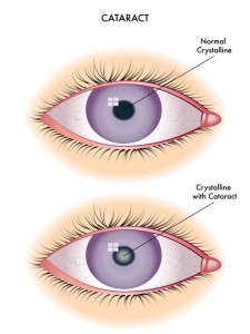 Cataract | Bellingham Optometrist | Eye Doctor | Glasses | Mount Baker Vision Center