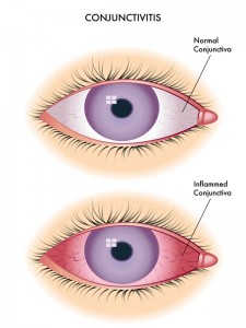 Conjunctivitis | Bellingham Optometrist | Eye Doctor | Glasses | Mount Baker Vision Center