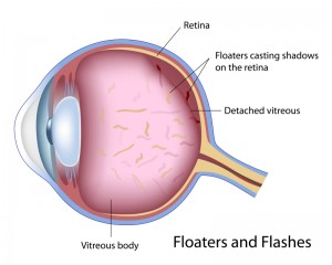Flashes Floaters | Bellingham Optometrist | Eye Doctor | Glasses | Mount Baker Vision Center