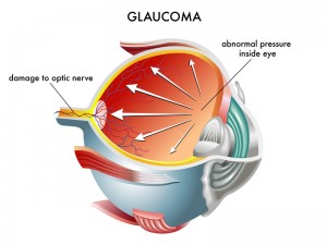 Glaucoma | Bellingham Optometrist | Eye Doctor | Glasses | Mount Baker Vision Center