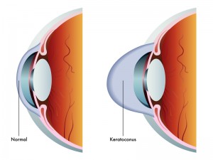 Keratoconus | Bellingham Optometrist | Eye Doctor | Glasses | Mount Baker Vision Center