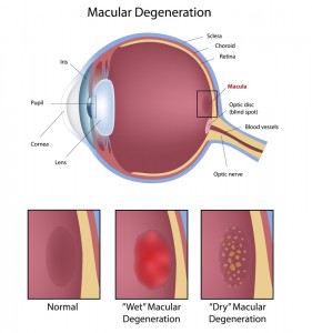Macular Degeneration | Bellingham Optometrist | Eye Doctor | Glasses | Mount Baker Vision Center